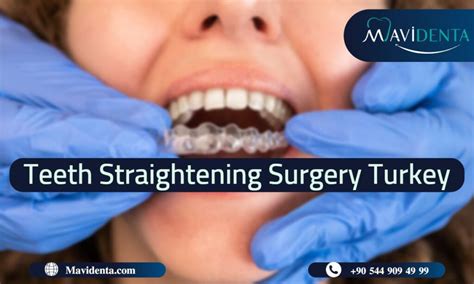 Guide To Teeth Straightening Surgery Turkey In 2023