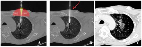 Jcm Free Full Text Safe Zone To Avoid Pneumothorax In A Ct Guided