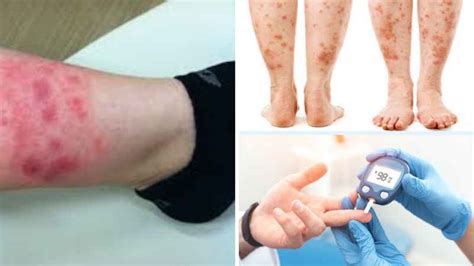 Diabetes Leg Swelling And Redness Treatment Home Remedies