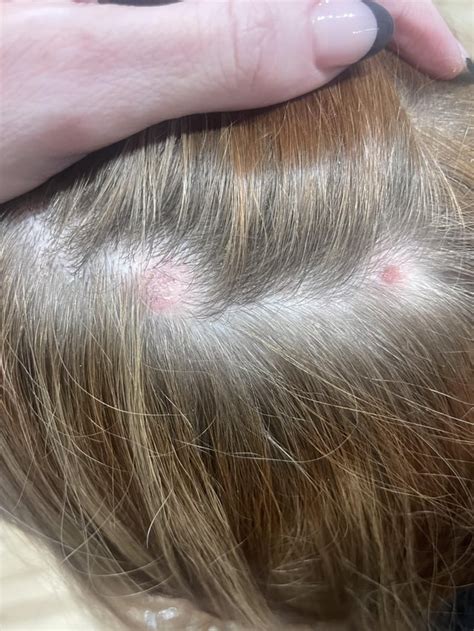 What Is On My Scalp I Have A Few Of These Sores Not All Showing In Photo Theyve Been Here