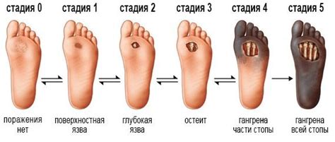 Симптомы гангрены - Как лечить гангрену