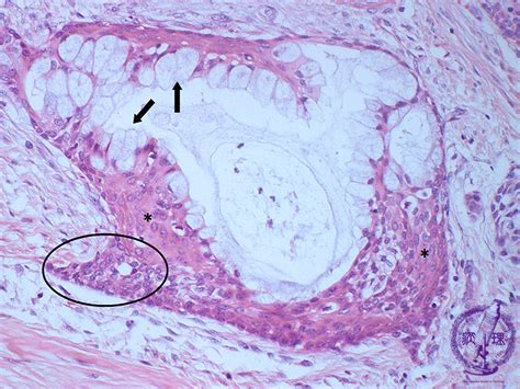 7oral Salivary Gland 7 Salivary Gland Tumor Mucoepidermoid