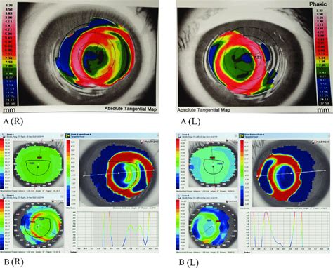 Corneal Topography Indicating Lens Decentration A 15 Month Visit B