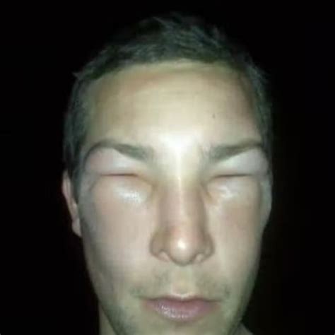 Bear Grylls shows horror swollen face after near-deadly bee sting ...