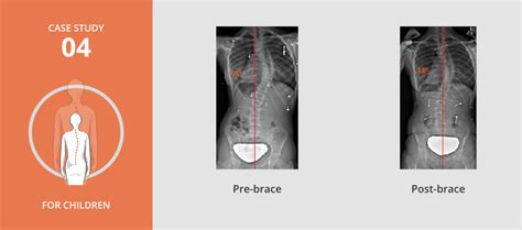 Pediatric Scoliosis Treatment - Scoliosis Centers of Boston MA and Jacksonville FL