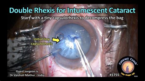 Cataractcoach Double Rhexis For Intumescent White Cataract Youtube