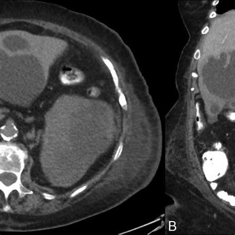 Contrast Enhanced Abdominal Computed Tomography A Transverse Image