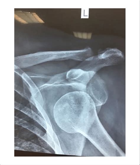 Ap X Ray Of The Shoulder Illustrating Anterior Shoulder Dislocation Download Scientific Diagram