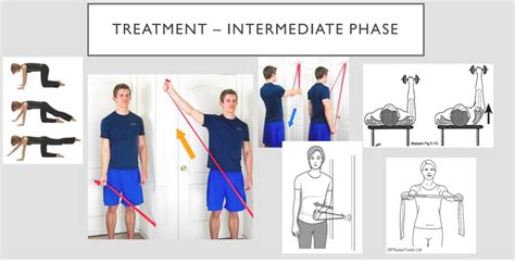 Shoulder Impingement Physio Newbies