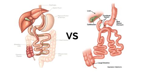 Bpd Ds Vs Sadi S Boehringer Labs