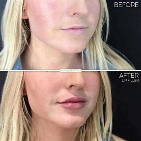 Juvly Aesthetics Juvederm Ultra For Lip Injection