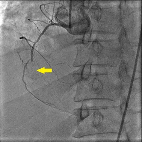 Totally occluded right coronary artery can be seen in the mid portion ...