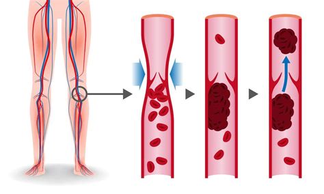 Thrombose Definition Arten Folgen Behandlung Pflege De