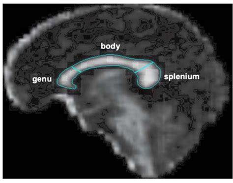 Midsagittal Fa Image Of A 47 Year Old Control Woman The Corpus