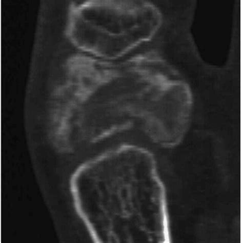 Ct Scan Exhibited A Lytic Bone Lesion With Intralesional Sclerosis And Download Scientific