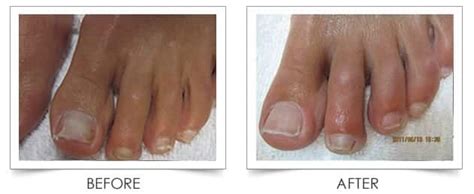 Columbia Laser Skin Center Nail Fungus Treatment - Before and After ...