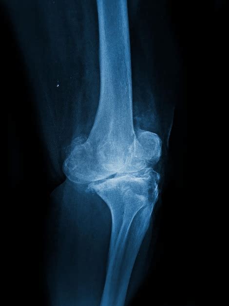 Premium Photo Osteoarthritis Knee Film Xray Ap Anterior Posterior