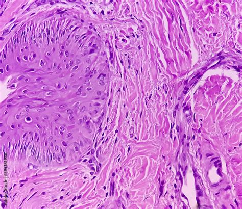 Great Toe Soft Tissue Biopsy Glomus Tumor Or Paragangliomas