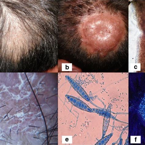 Tinea Capitis Current Review Of The Literature Request Pdf