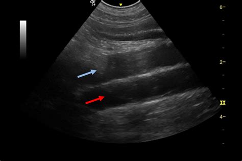 Aorta Anatomy Ultrasound