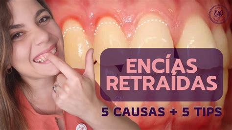 Las ENCÍAS RETRAÍDAS tienen solución 5 CAUSAS y 5 TIPS para