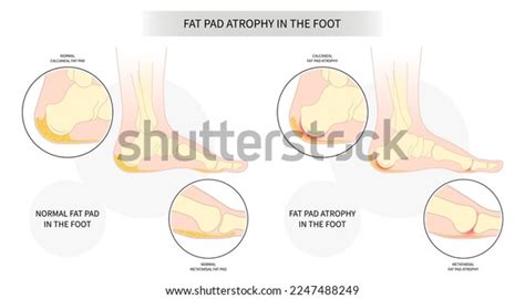 Plantar Fat Pad Atrophy Painful High Stock Vector Royalty Free