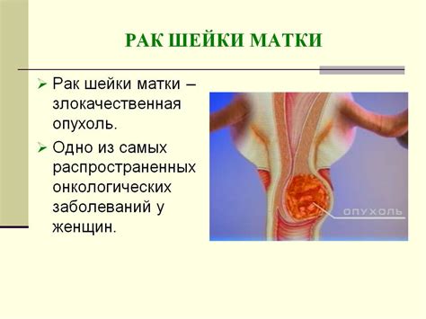 Лечение рака шейки матки: лечение хирургия, химиотерапия, лучевая