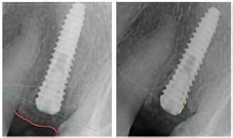 Digital Radiograph Scan Baseline Digital Periapical X Ray A Month