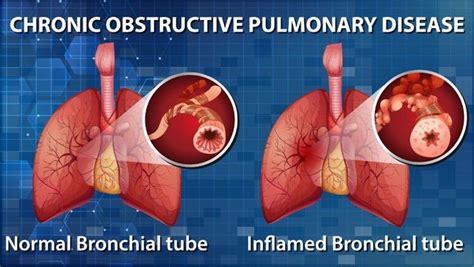 Chronic Obstructive Pulmonary Disease Copd