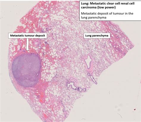 Lung Metastatic Carcinoma Nus Pathweb Nus Pathweb