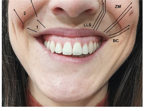 Different Muscles Involved During A Maximum Smile The Superior Lip And