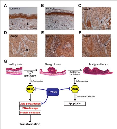 Expression Of Prdx In Human Sccs And Postulated Mechanism Of Action Of