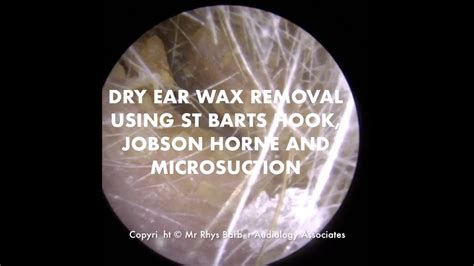 Dry Ear Wax Removal In A Hairy Ear Canal Using St Barts Hook