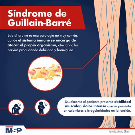 Sindrome De Guillain Barre Cid RETOEDU