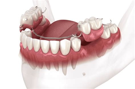 Wondering How Much Dentures Cost Heres An Explanation