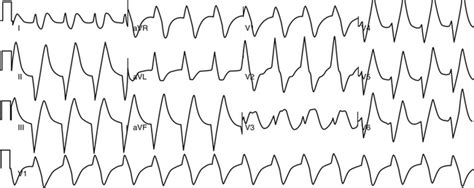 Approach To Wide Qrs Complex Tachycardias Musculoskeletal Key