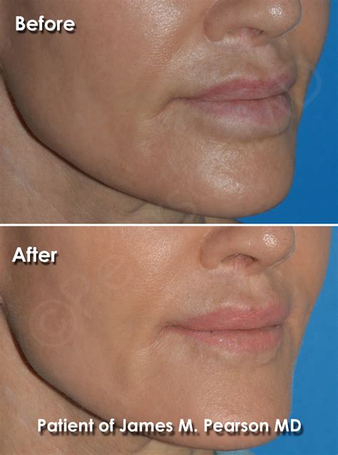 Corner Lip Lift Dr James Pearson Facial Plastic Surgery