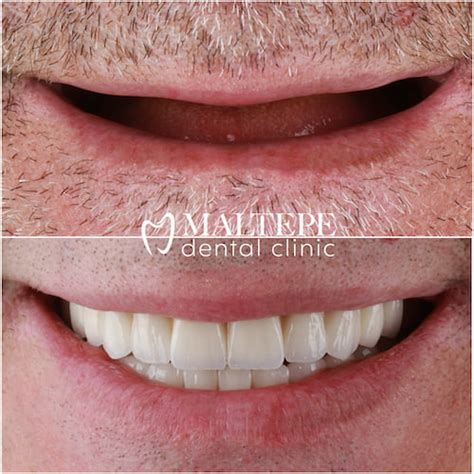 Full Mouth Dental Implants Maltepe Dental Clinic