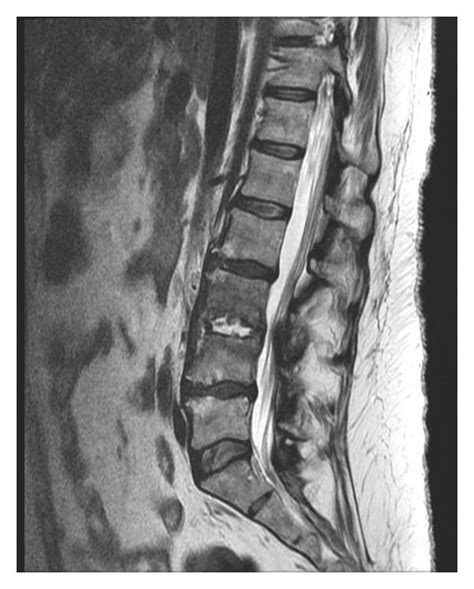 Mri Thoracic Spine Lateral View Reveals Discitis Osteomyelitis At