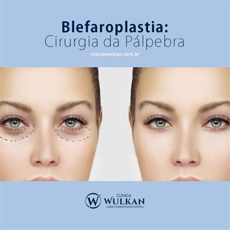 Blefaroplastia cirurgia da pálpebra Dermatologista Especialista