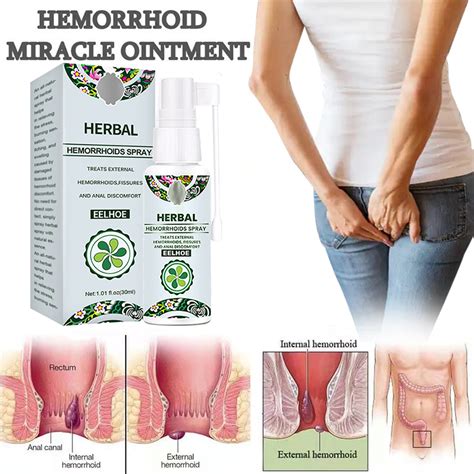 【100 Original】eelhoe Gamot Sa Kati Kati Sa Balat Hemorrhoids Miracle Ointment Hemorrhoids Cream