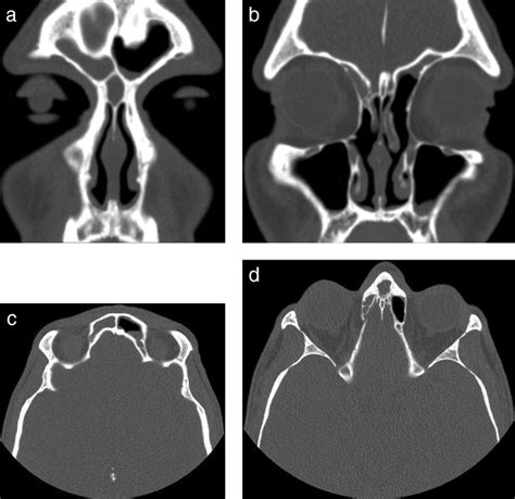 Preoperative Computed Tomography CT Scans For Patient 2 A Coronal