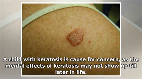 Keratosis Treatment How To Remove Keratosis Home Youtube