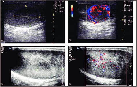 Ultrasound Results A B Limited Type The Size Of The Right Testicle