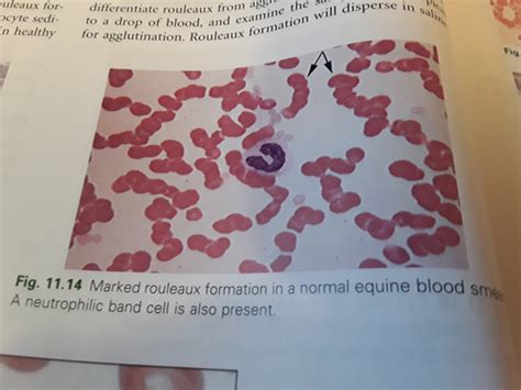 Clinical Pathology Part 7 Hematology And Hemostasis Erythrocyte