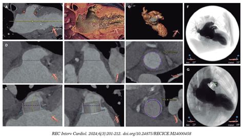 Role Of Computed Tomography In Transcatheter Coronary And Structural