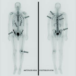 Whole Body Bone Scintigraphy M Tc Methylene Diphosphonate In A