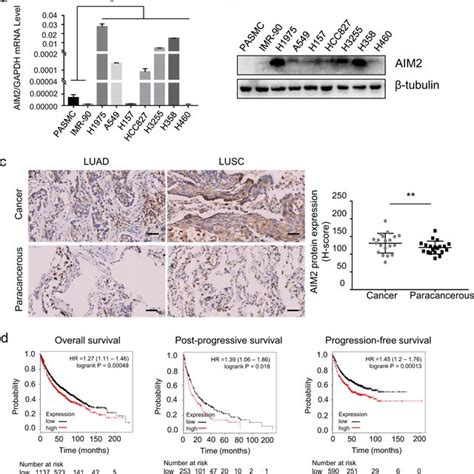 Aim Is Highly Expressed In Nsclc Cells And Its Expression Correlates