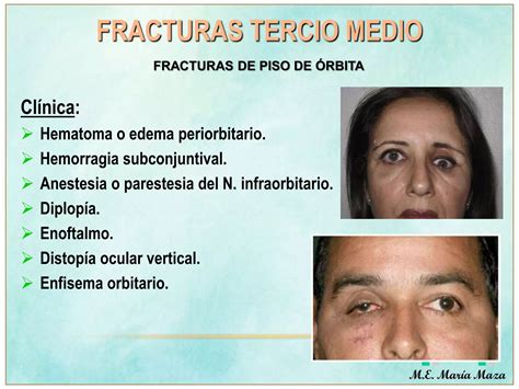 Fracturas Faciales Tercio Superior Y Medio Ppt