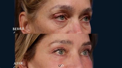 Eyelid Lift Surgery Co Laser Before And After Dr David Stoker